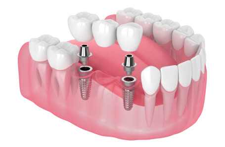 a graphic of dental implants replacing multiple teeth