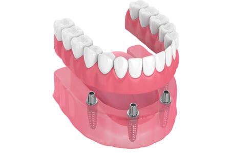 a graphic of overdentures