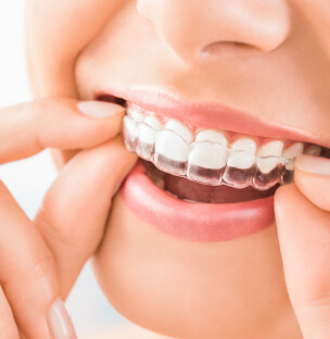 an Invisalign clear aligner tray being put on the teeth