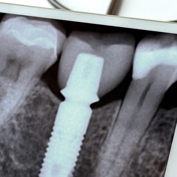 a dental x-ray with dental implants in the jawbone