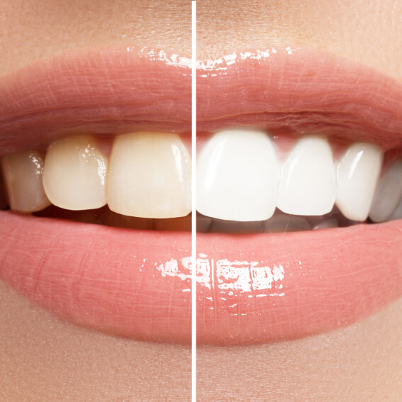 a side by side photo of half yellow teeth compared to half white teeth