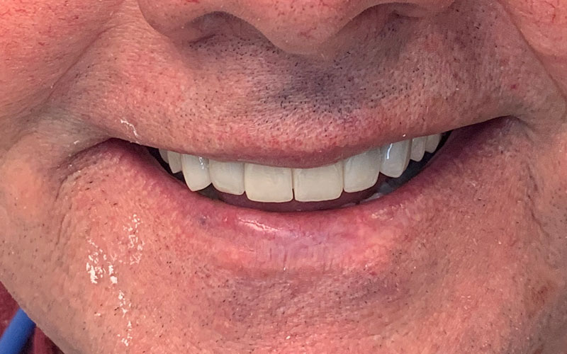 After picture of white and straight front teeth