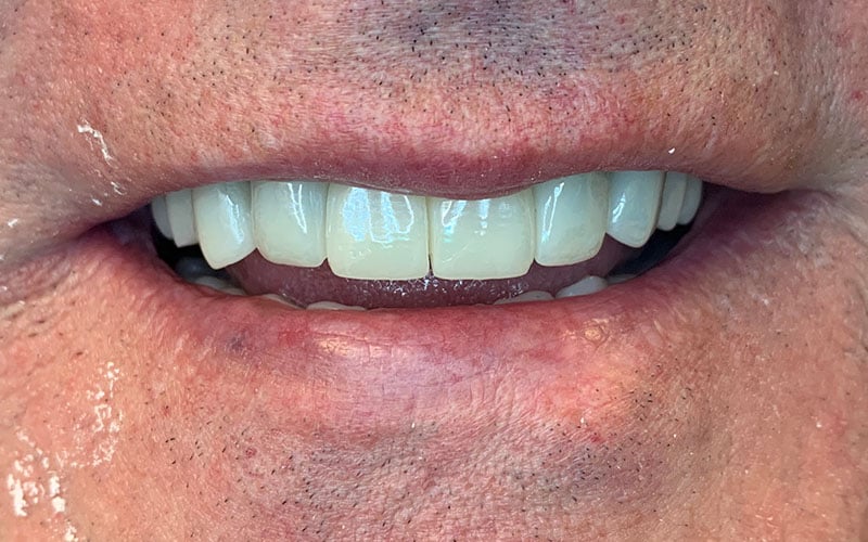 After picture of front teeth that are straight and white