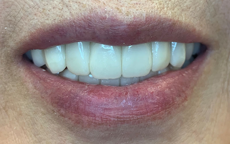 After picture of patients front teeth that are straight and white