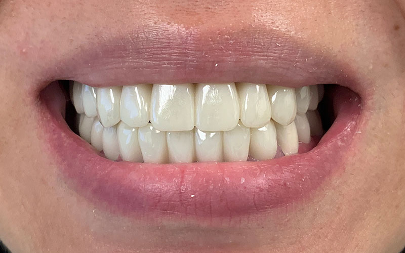 after picture of a full set of teeth that are straight and shiny