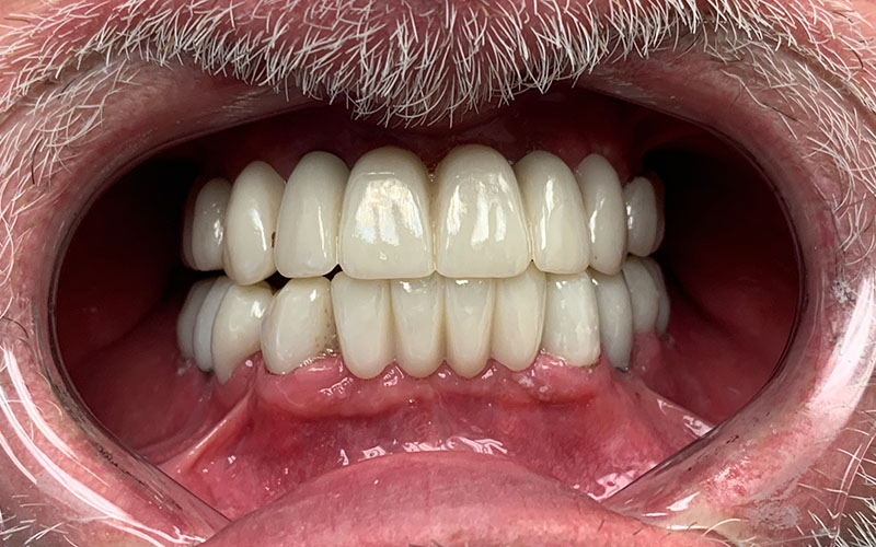 after picture of full set of teeth that are shiny and straight