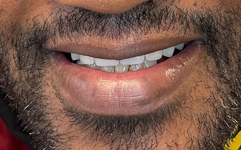 After picture of patient with a new full set of shiny teeth