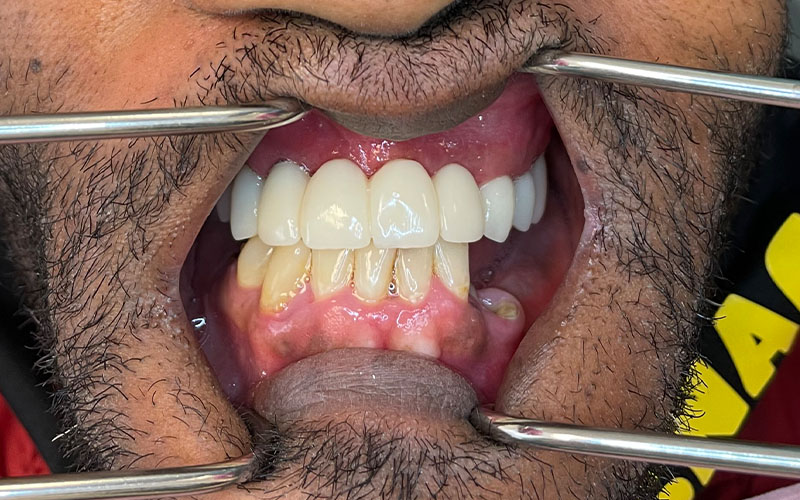 After picture of patient with new front teeth that are shiny