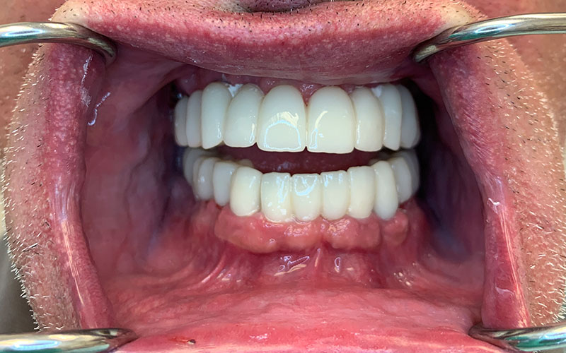 after picture of a new full set of naturally beautiful teeth