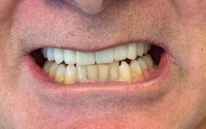 after picture of front teeth that are now white and straight