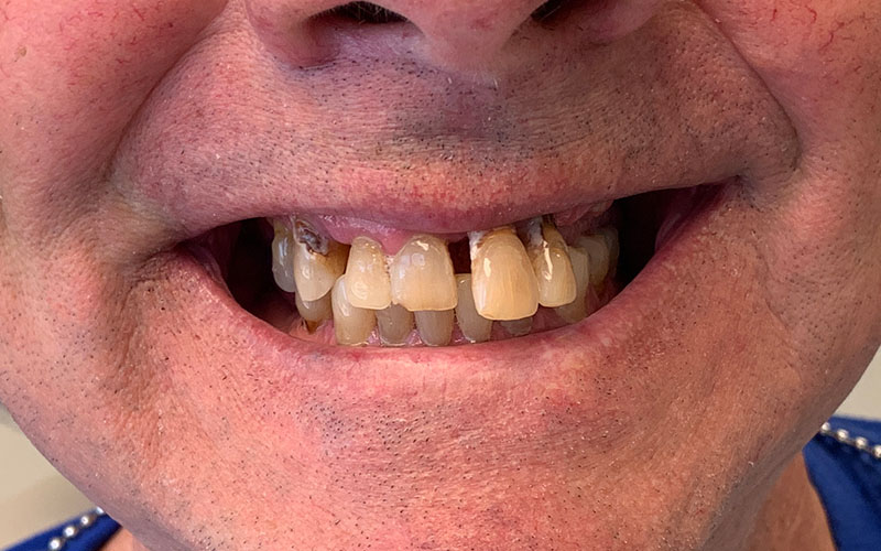 Before picture of crooked and gapped yellowed teeth