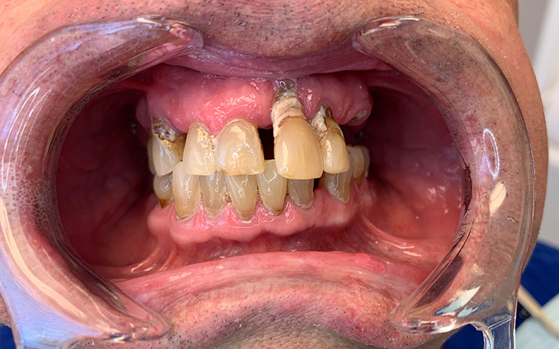 Before picture of patient missing teeth, with crooked, decayed, and yellow teeth on both arches