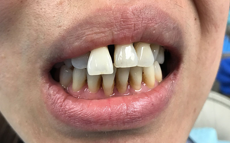 before picture of patients teeth that are uneven in size, gapped, and crooked