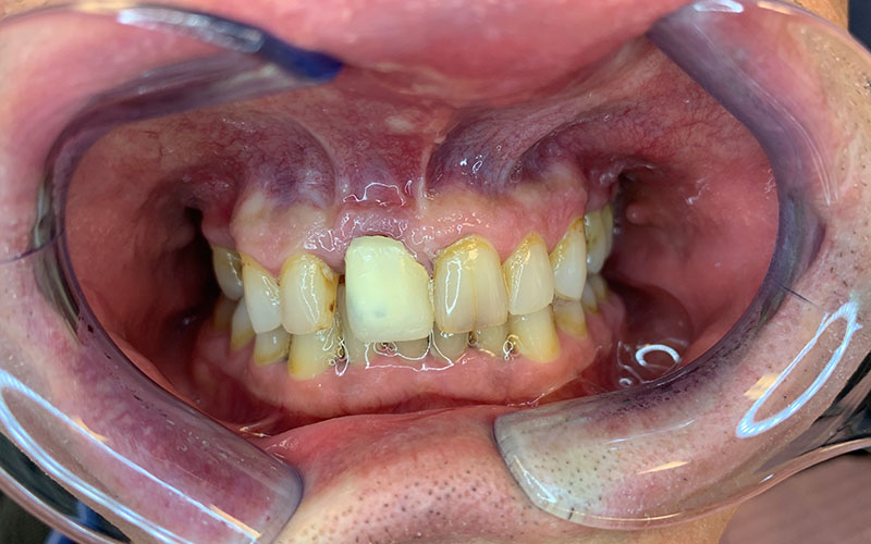 before picture of decayed teeth with an overbite