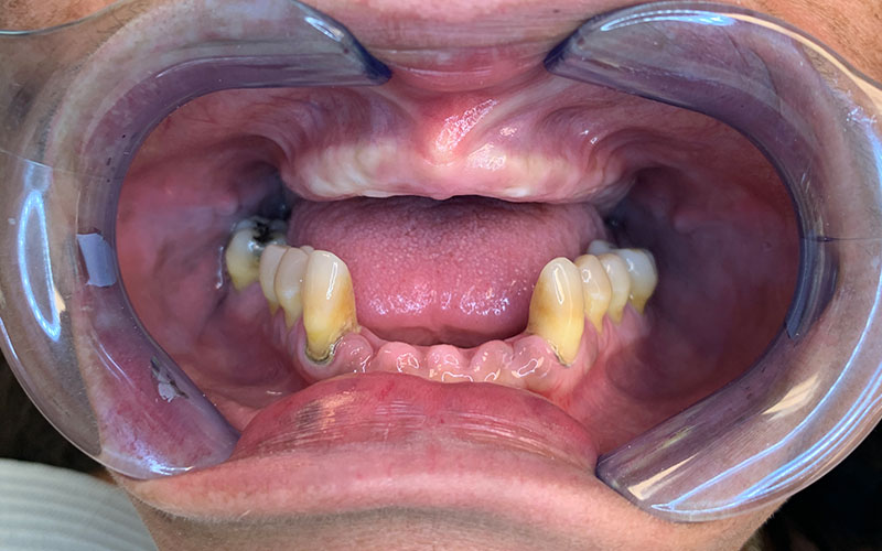 before picture of patient with no front teeth and missing bottom front teeth