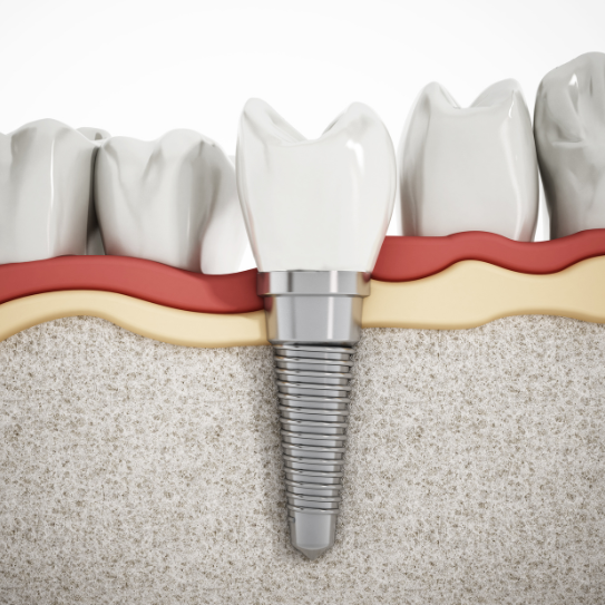 dental implants in sudbury