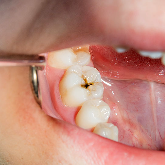 dental clinic in Sudbury cavities